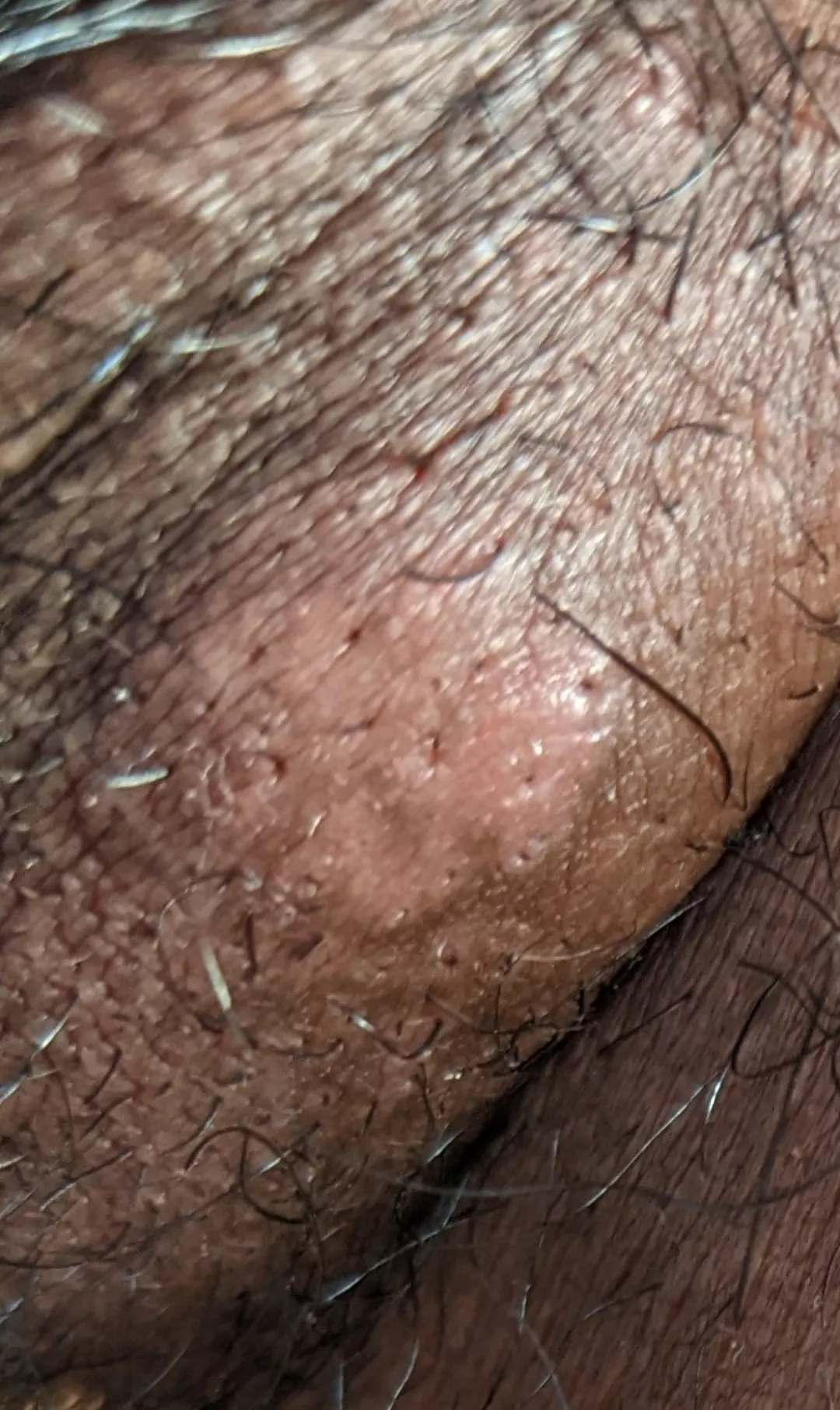 ingrown hair (?) in pubic area that looks weird, lumpy, hard, is painful & leaks fluid when pricked and squeezed