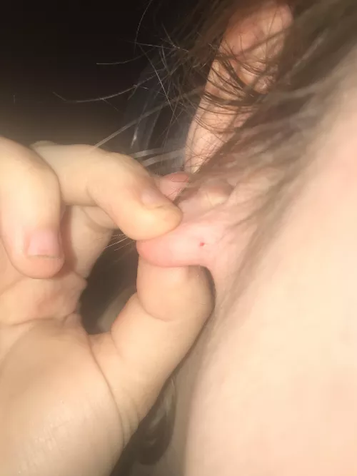 “Minor” Blackhead on my ear left this gaper! Sorry, didn’t film bc I didn’t think it would be interesting