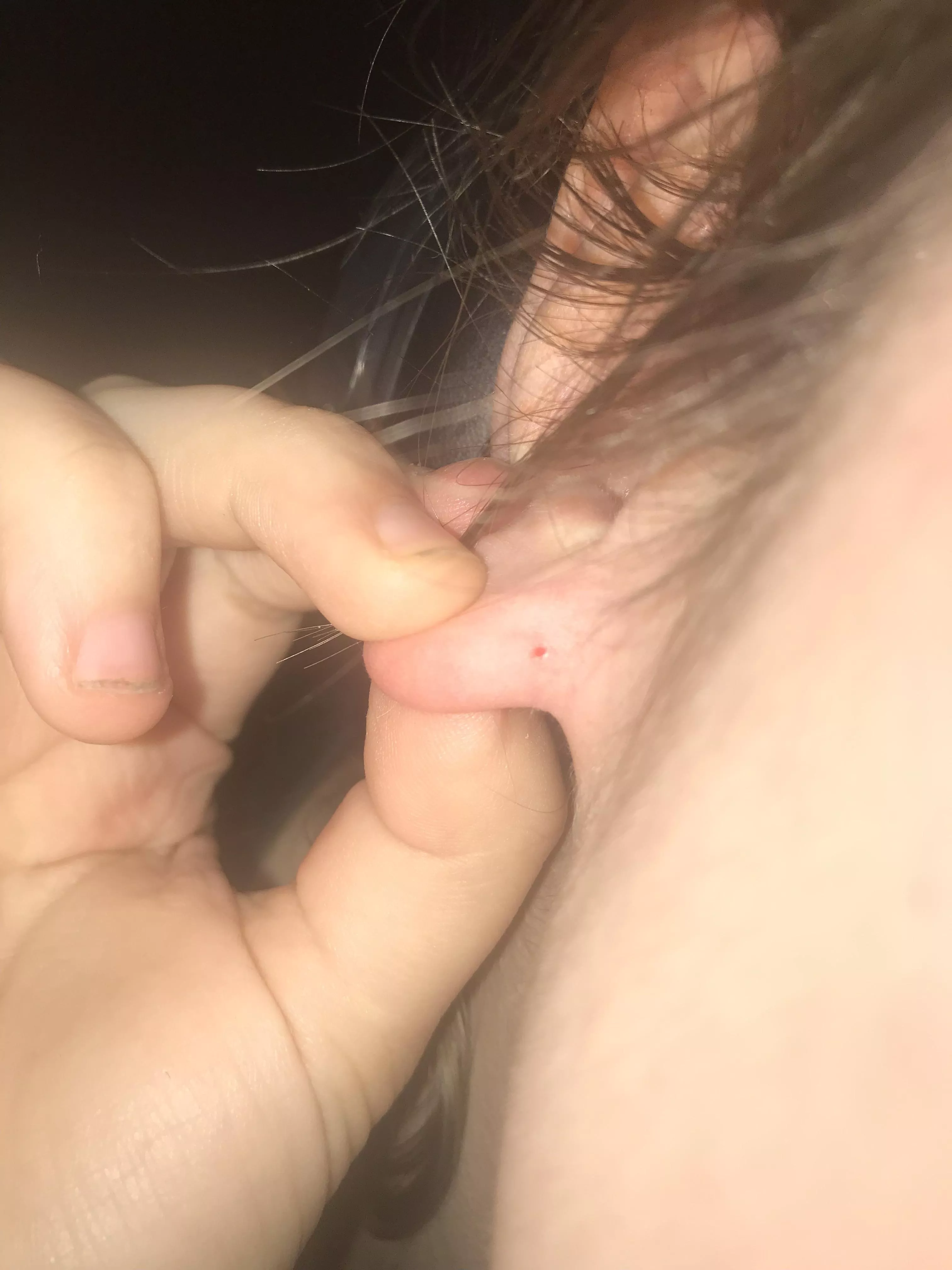“Minor” Blackhead on my ear left this gaper! Sorry, didn’t film bc I didn’t think it would be interesting
