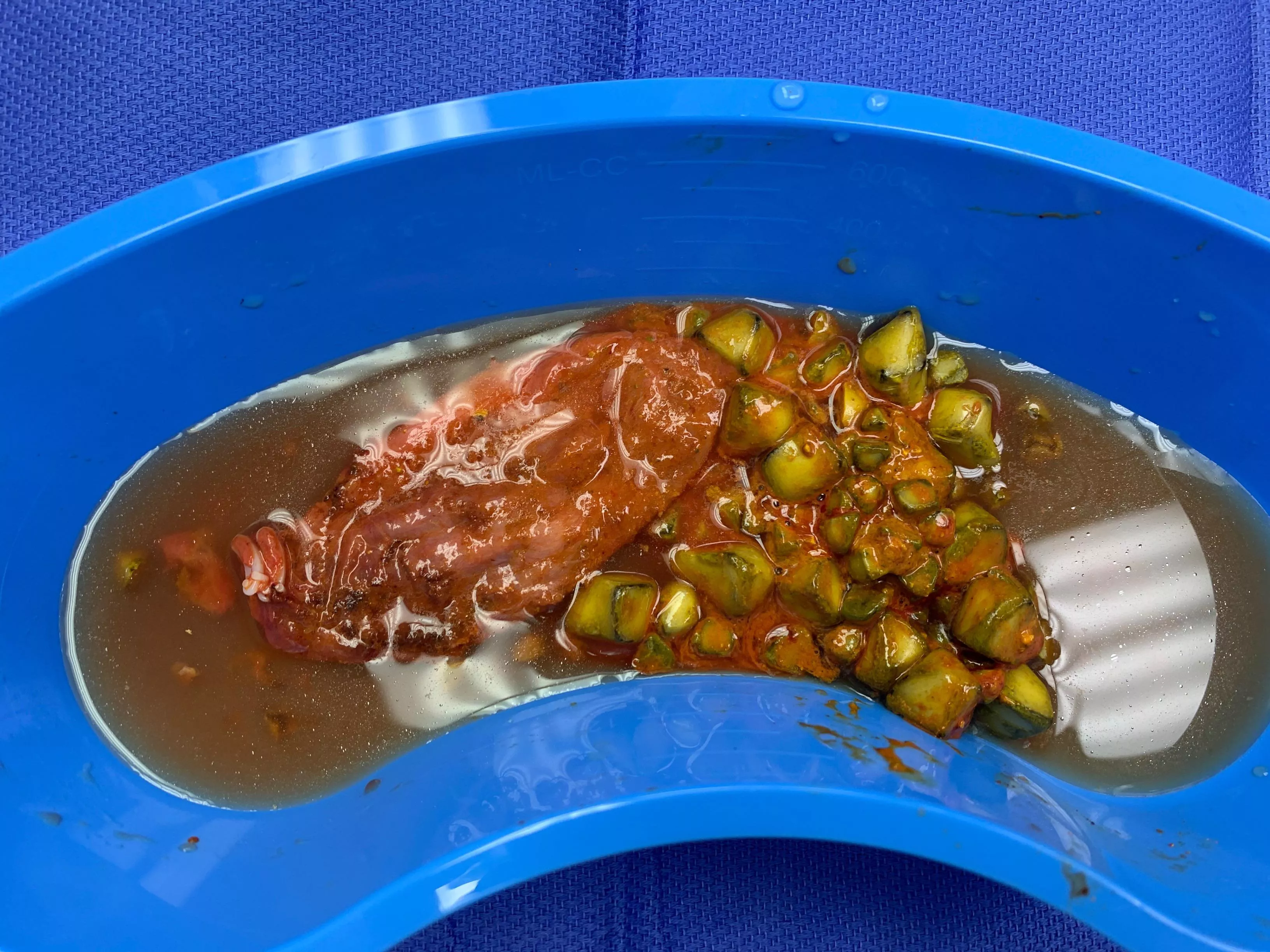 Surgery and organ in photo I don’t see blood but it may ick you out. Gallbladder surgery, so many stones. I legit thought I was having a heart attack