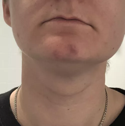 A cautionary tale: bruises from squeezing too hard