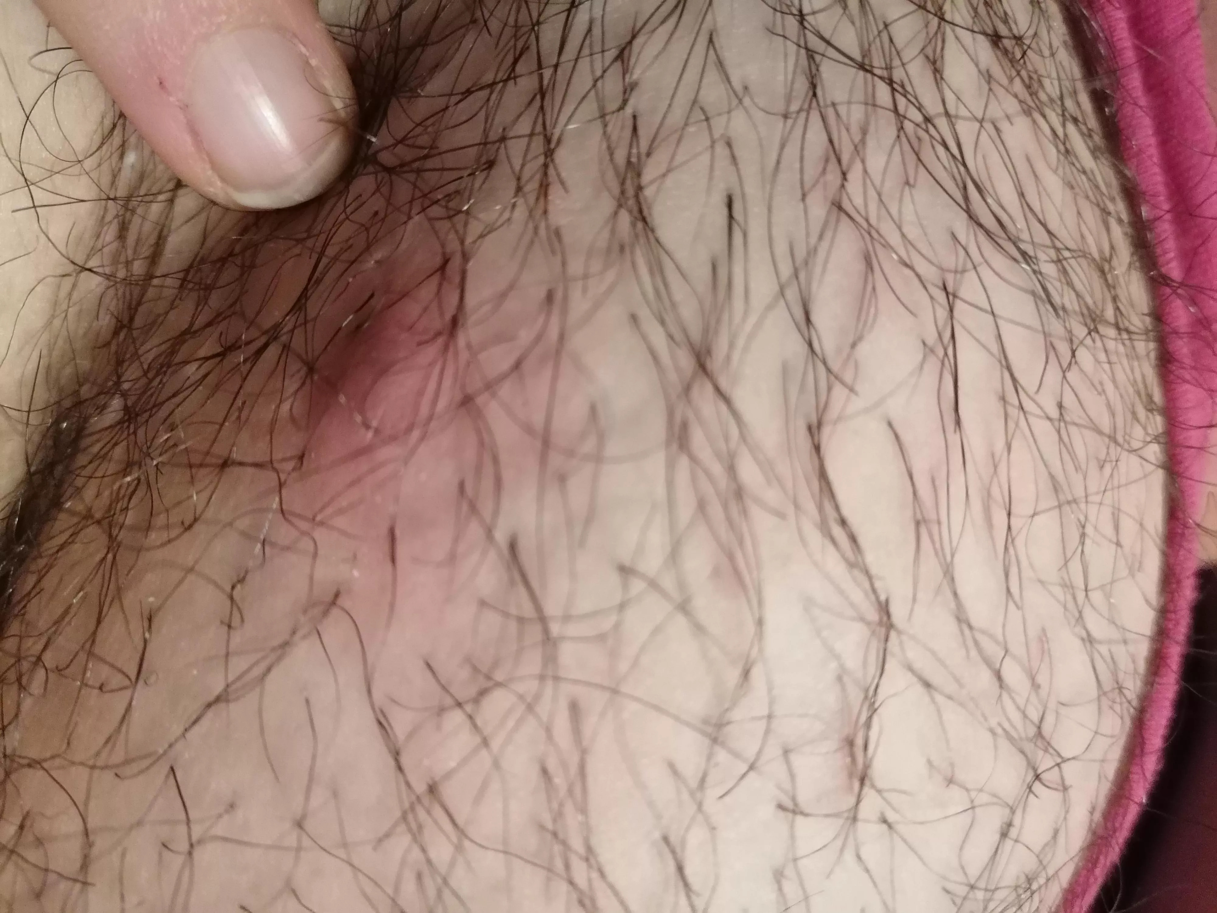 Found this around my pubic area. It may be an ingrown but it's too painful to touch. What do??