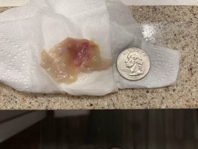 I blew my nose after using a neti pot and this bad boy came out