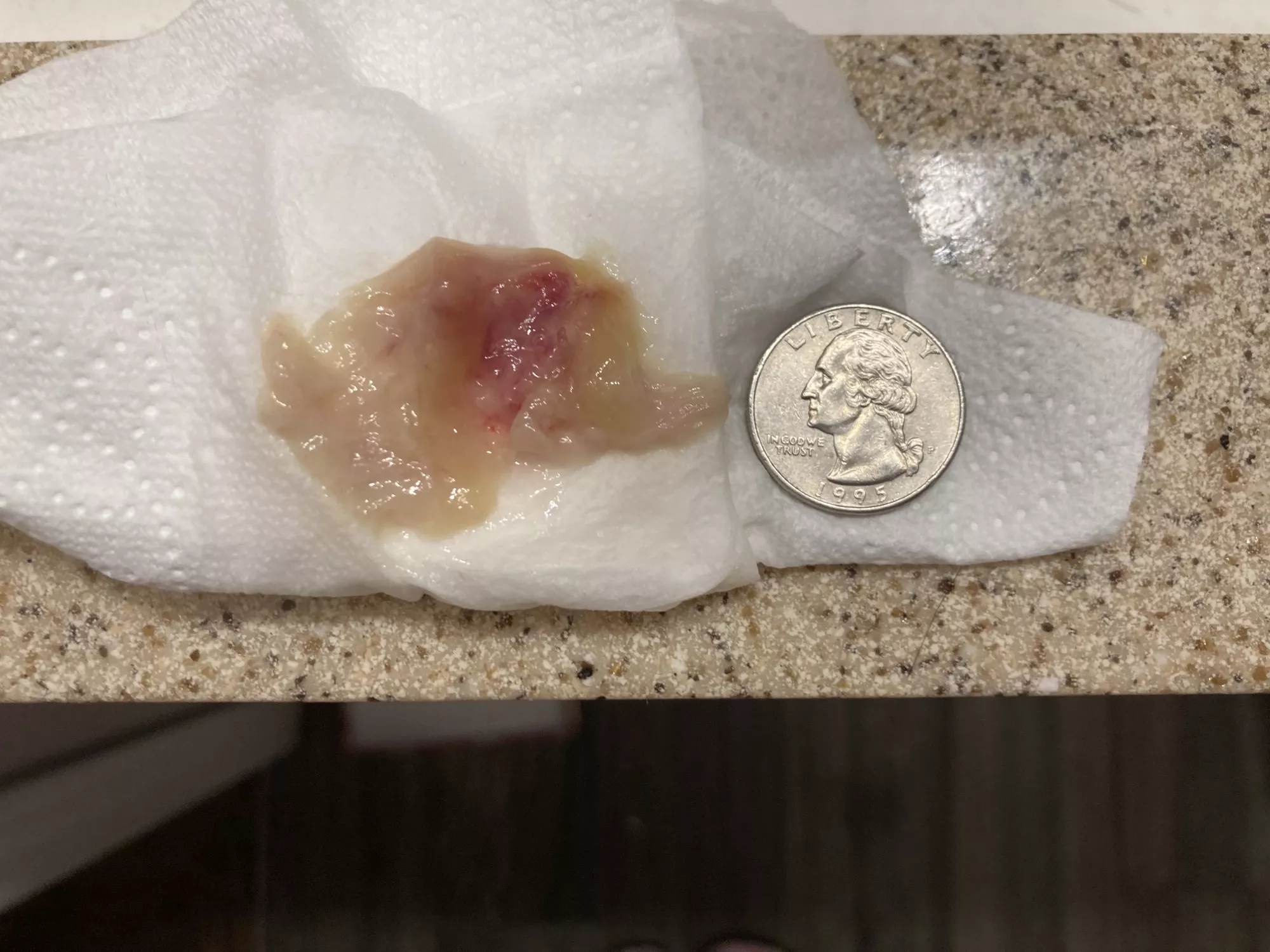 I blew my nose after using a neti pot and this bad boy came out