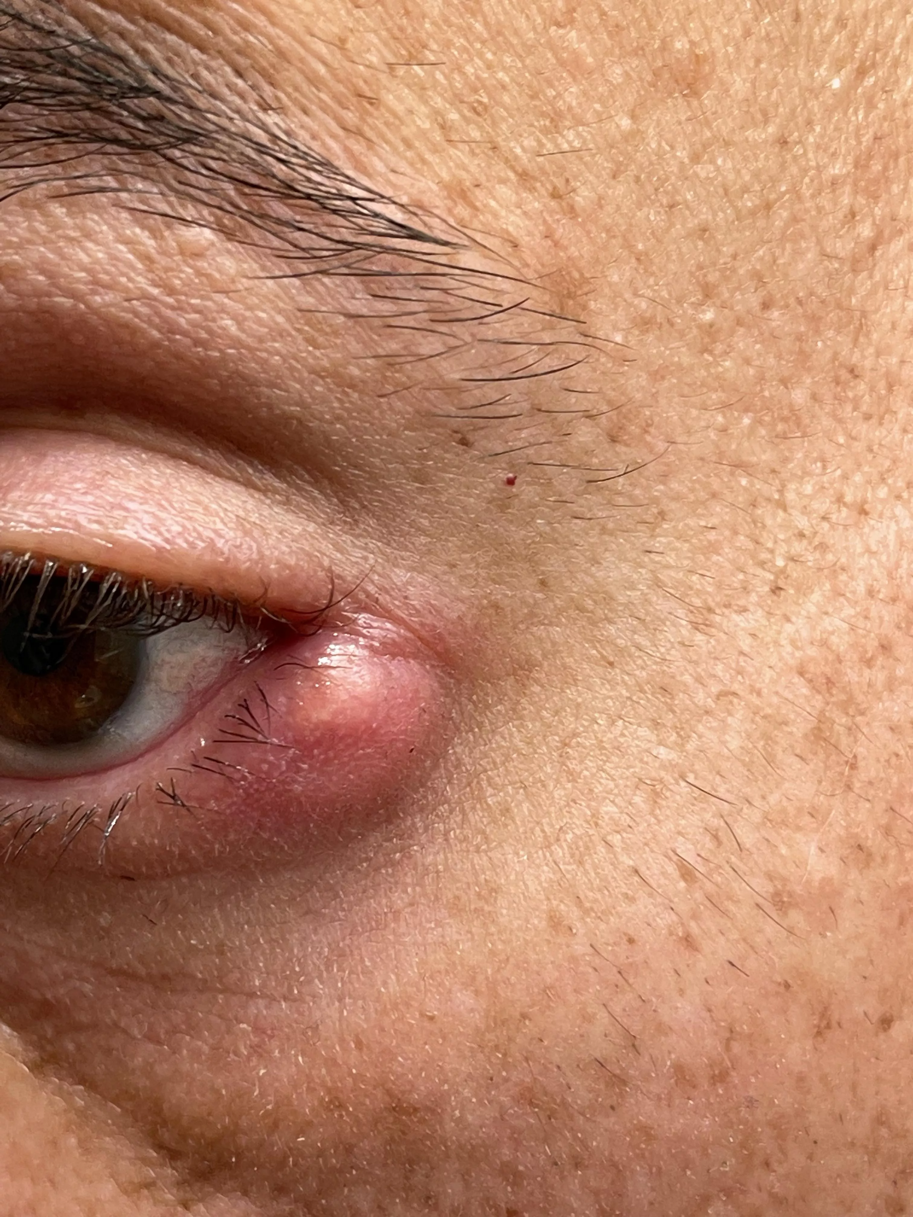 I know I can’t pop this, but I also know that it would be instant relief if it did pop.