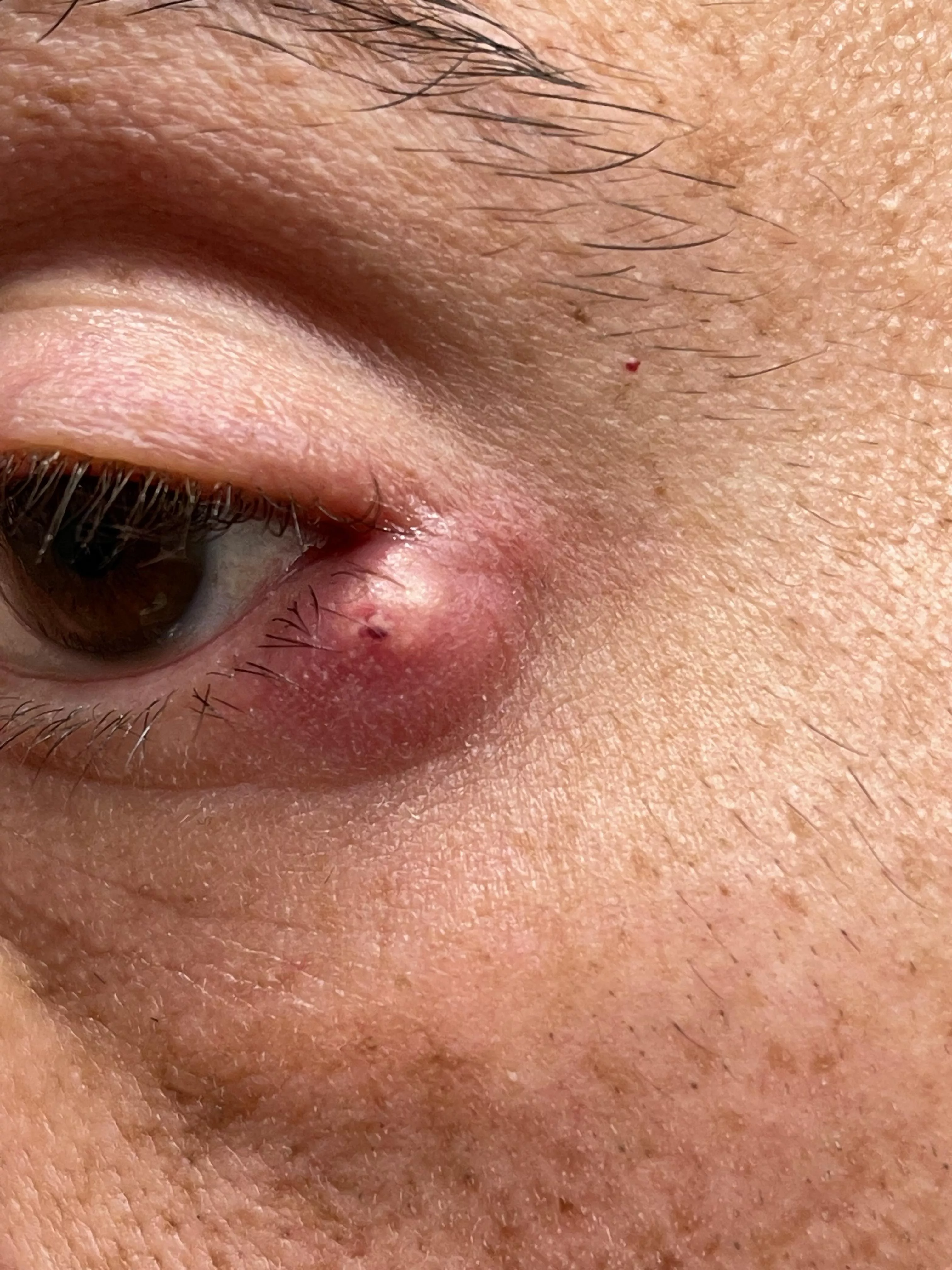 Update: it’s probably going to pop on its own imminently. Not as painful today as it was last night. I’m tempted to use a blood sugar lancet to drain it without squeezing, but I probably won’t.