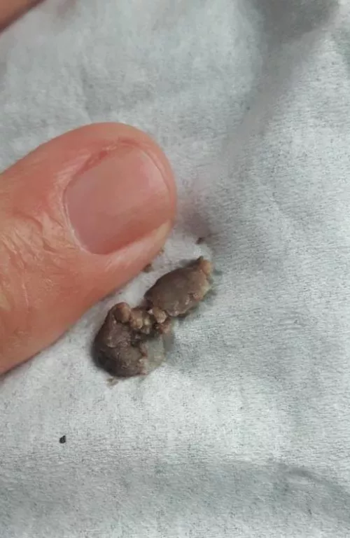 Why do my lacrimal duct clogs shoot into my mouth and I cough them up when theirs come out their nose? I feel like I'm getting the short end of the stick. Mine are really dark too...