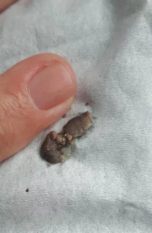 Why do my lacrimal duct clogs shoot into my mouth and I cough them up when theirs come out their nose? I feel like I'm getting the short end of the stick. Mine are really dark too...