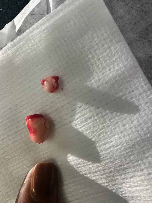 8-year old Pilar cyst and its friend. Thumb for scale.