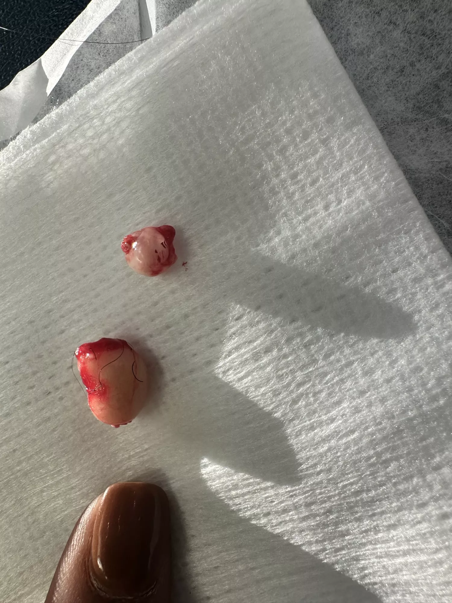 8-year old Pilar cyst and its friend. Thumb for scale.