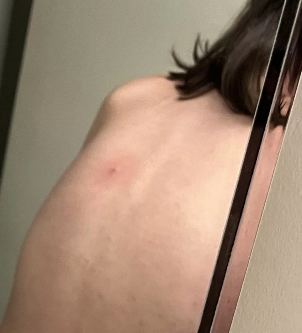 Back pimple that looks like a nipple- I call it my bimpple