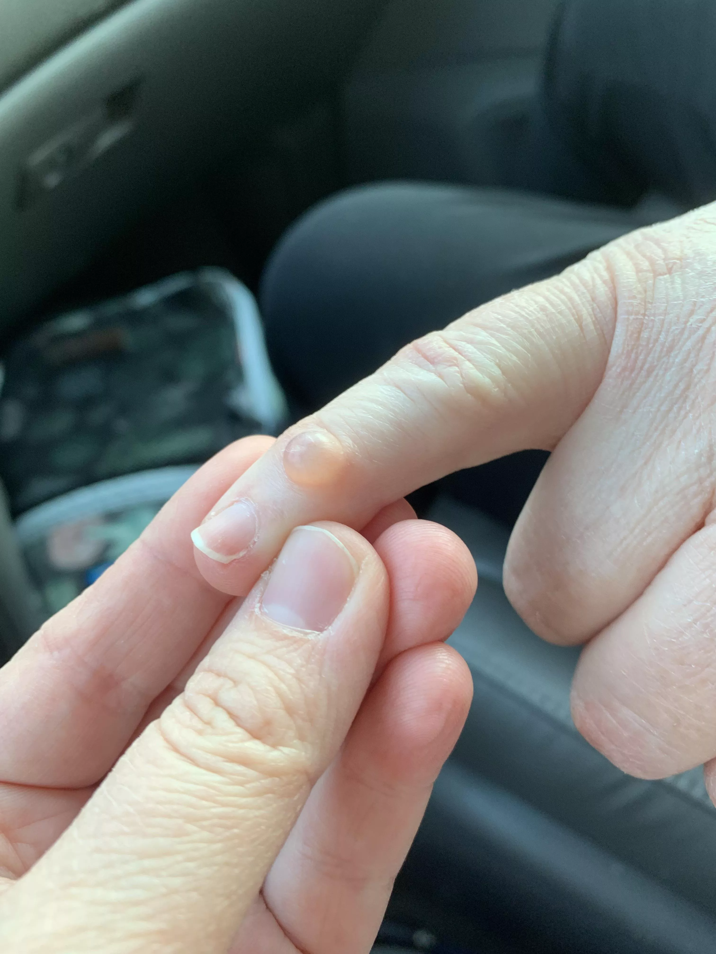 Digital Mucous Cyst on my mom’s pinky. Maybe this isn’t allowed because it actually shouldn’t be popped (delete, if so). It’s actually joint fluid inside there that’s leaking out. To fix it she’s going have a hand specialist sand down the spo