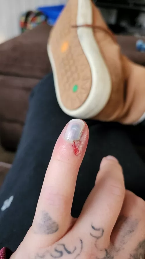 pinky sploded should I drain it