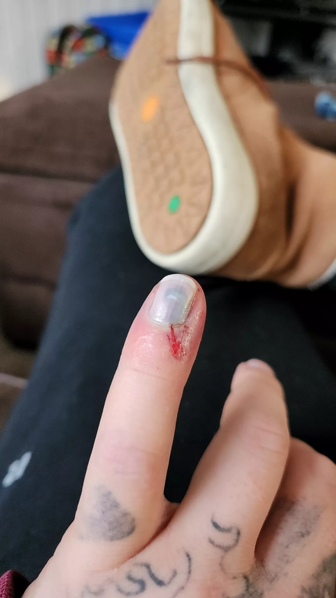 pinky sploded should I drain it