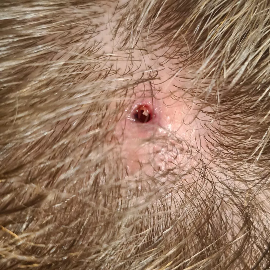 popped my 20yr old cyst 2 days ago. does it look like it's doing OK?