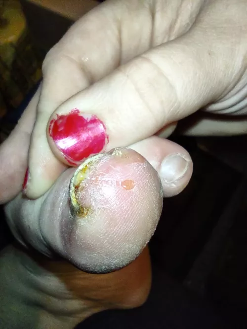 forbidden toenail pop from stubbing it on a plague pumpkin