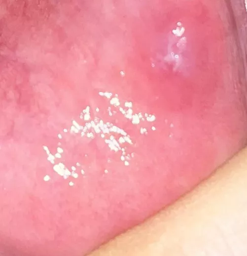 Hi guys. How can I deal with this spot that keeps filling with pus from an accidental bite?