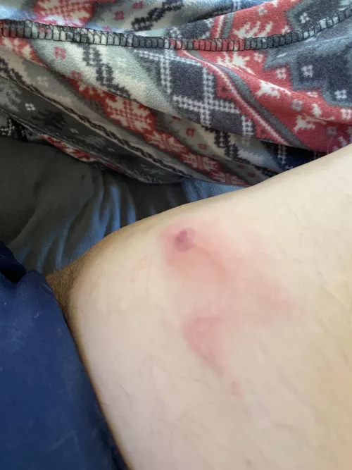 NSFW, infected cyst. Hurts. How should I pop