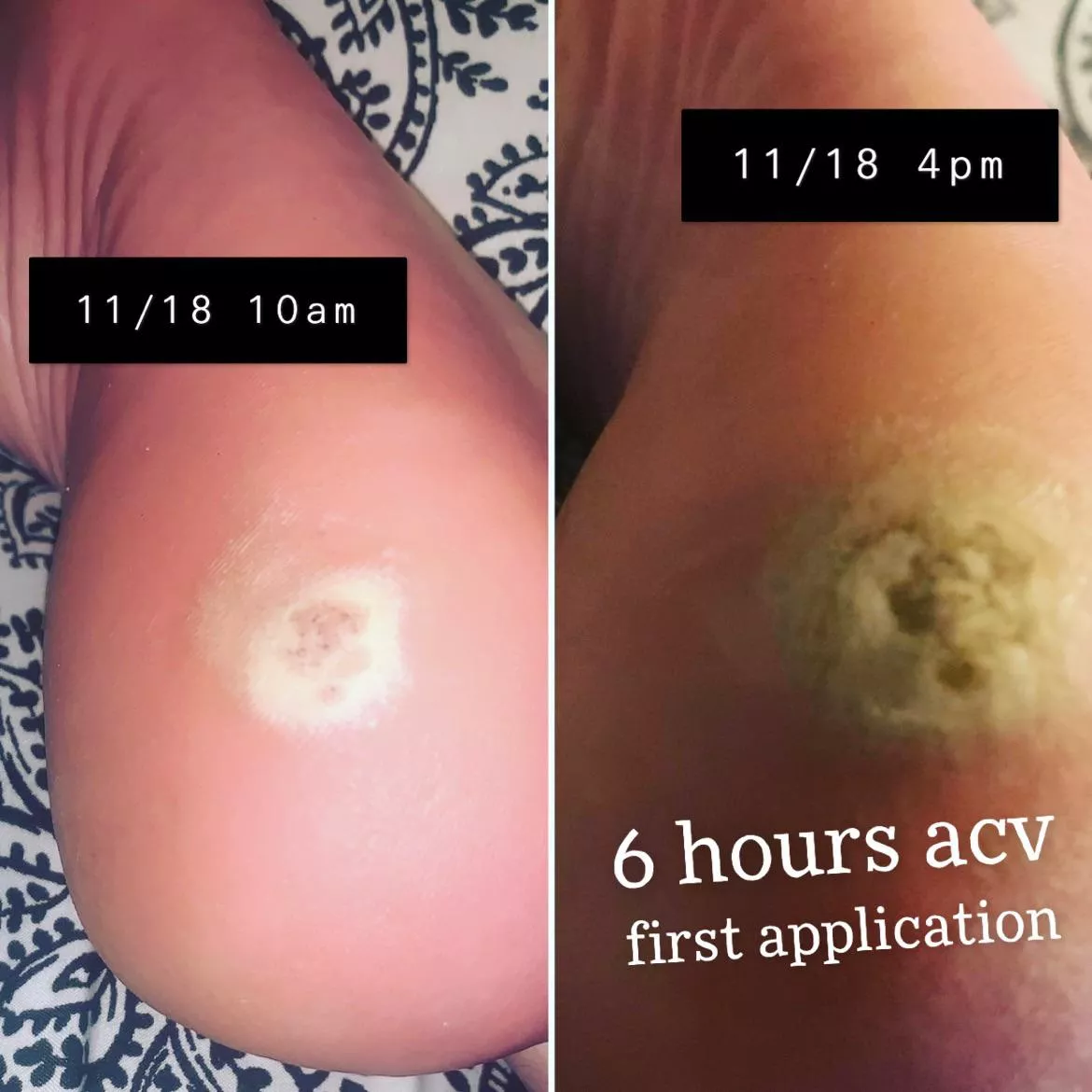 squeeze it like a zit? …or… like whatever’svinside a wart like this? you can do that? do all warts get a tail? yours is pretty. this is mine.