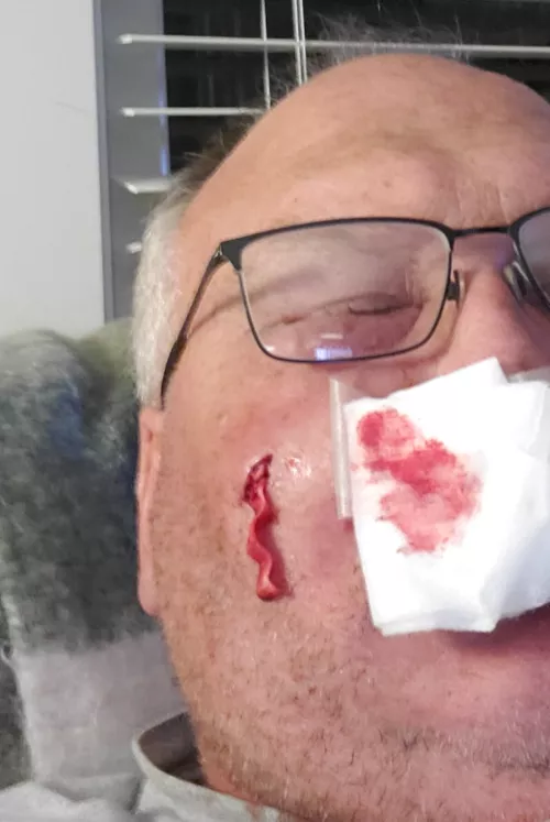 Staph infection. Doc wouldn't let me film him draining the abscess, but I will try again to film him remove the packing.