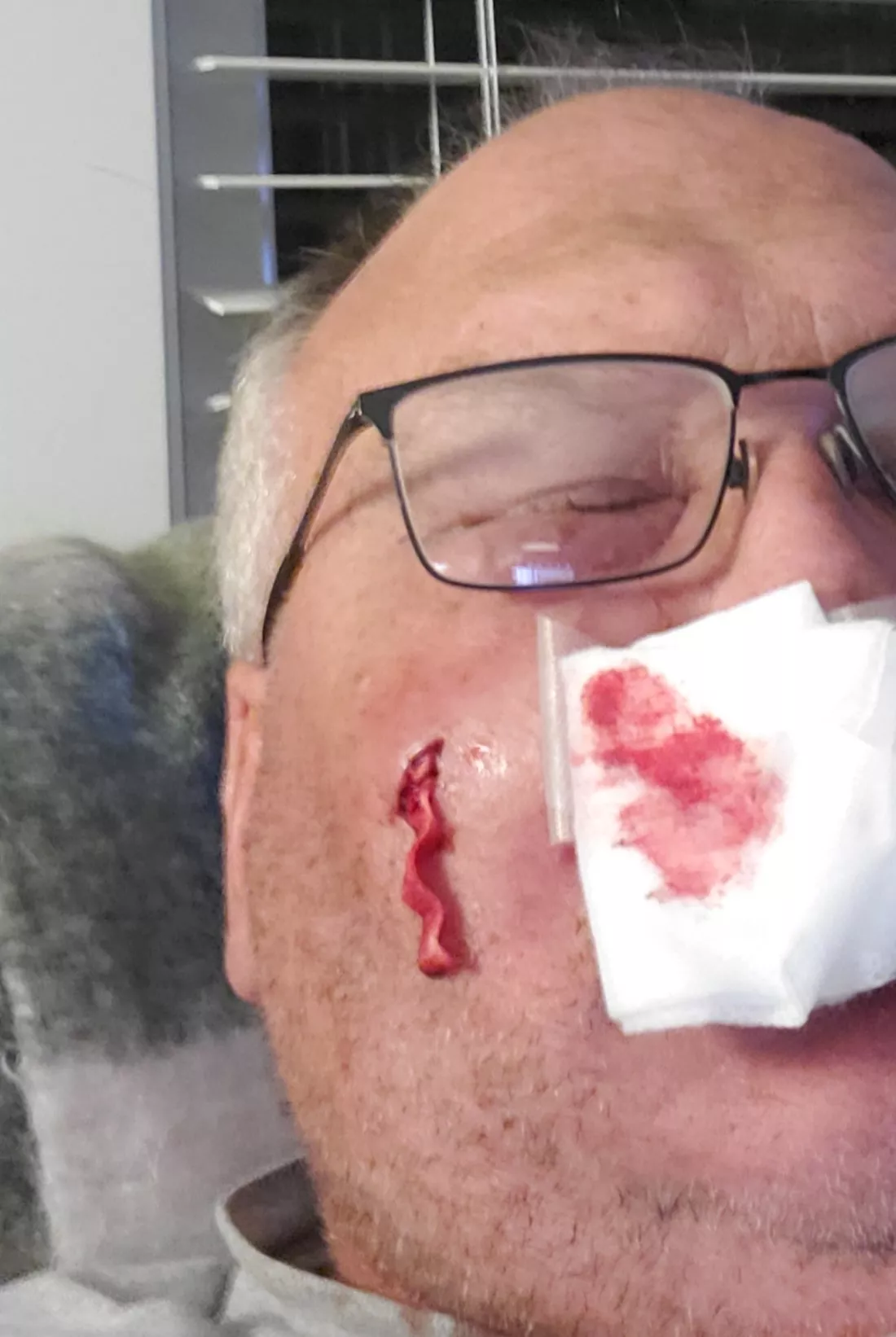 Staph infection. Doc wouldn't let me film him draining the abscess, but I will try again to film him remove the packing.