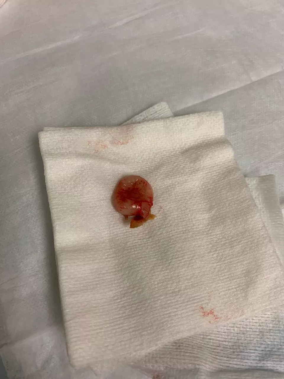 This quarter-sized cyst has been giving me headaches since I was in high school. I finally had it removed 15 years later, and it's so amazing how my head no longer hurts. I'm feeling so much better.