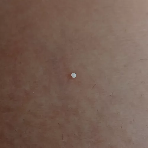 This white pearl just popped out of a keloid scar I have. Hard af.