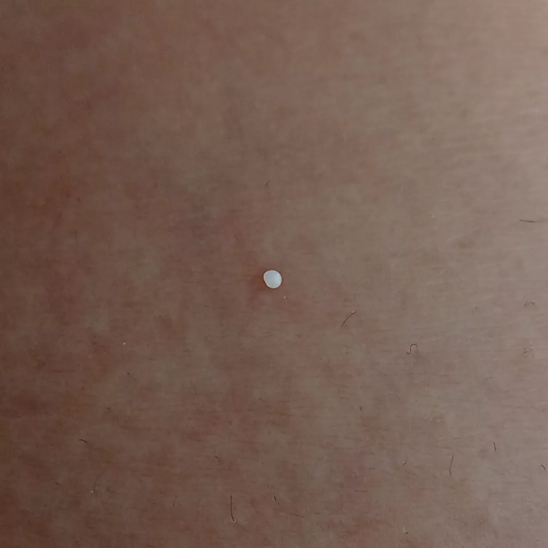 This white pearl just popped out of a keloid scar I have. Hard af.
