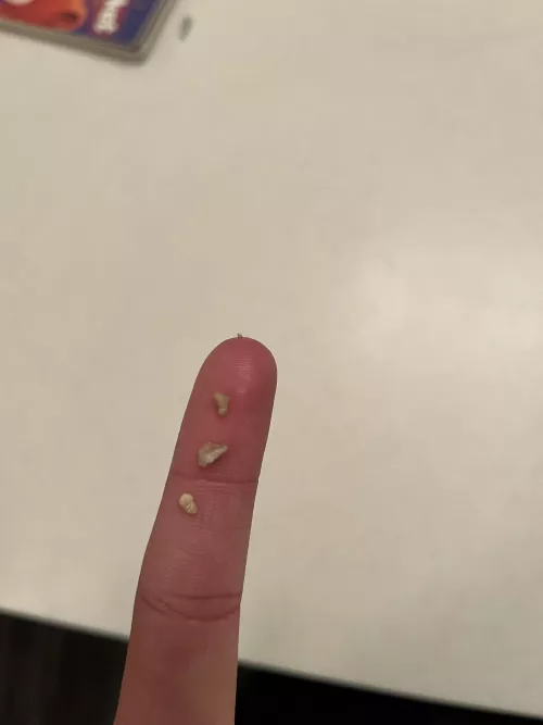 Biggest tonsil stones ive had all at once!