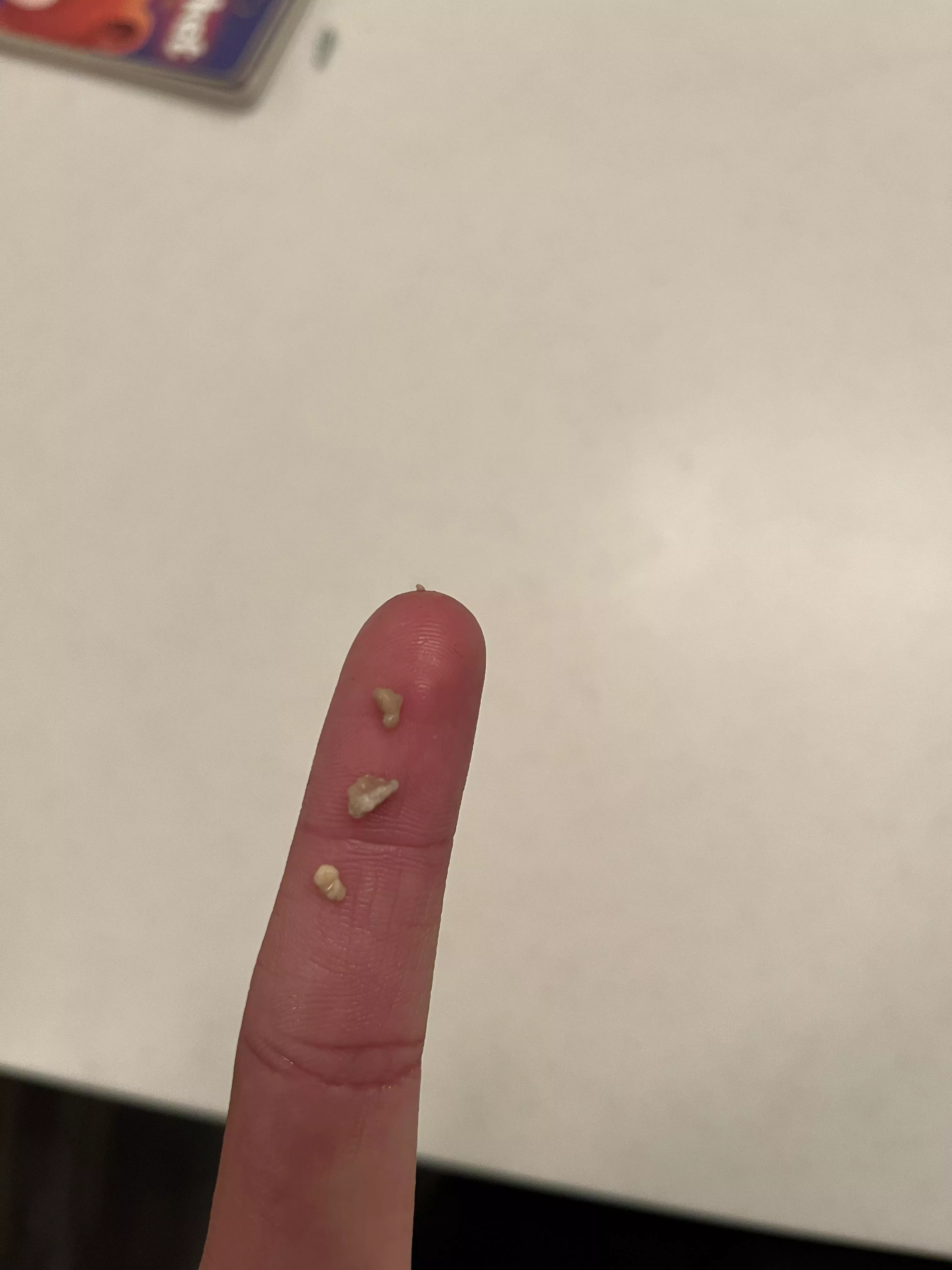 Biggest tonsil stones ive had all at once!