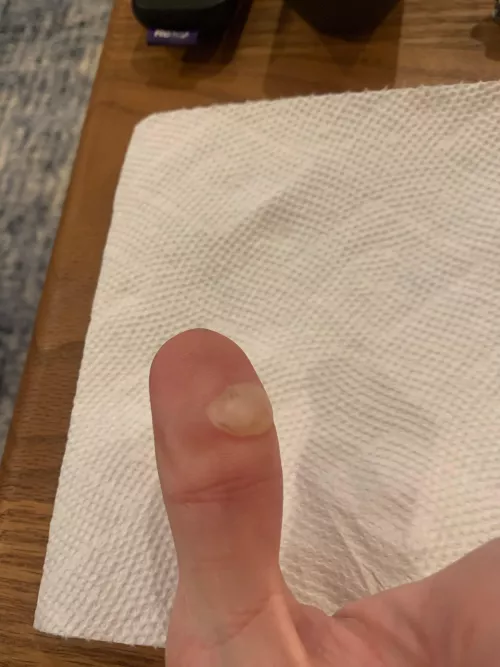 Burned myself the other day. Should I pierce it with a needle or leave it?