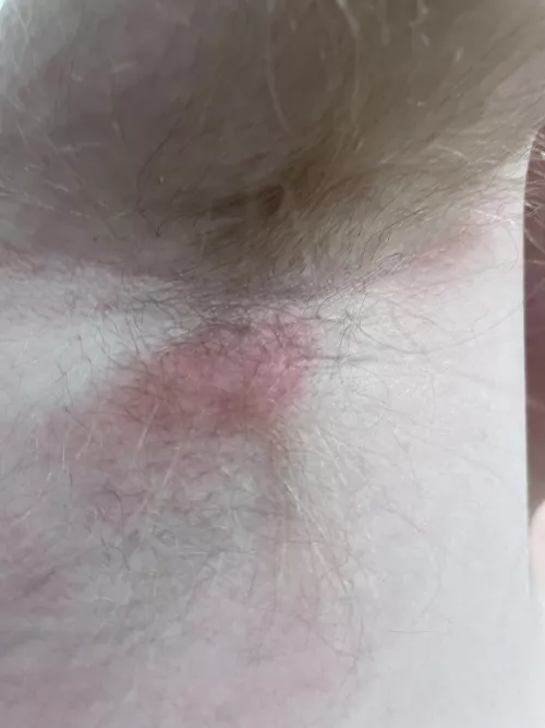 Flair up of what my derm thinks is an epidermal inclusion cyst under my armpit. This is the worst/most painful it has ever been, I can’t even lift my arm. Going back to derm tomorrow.