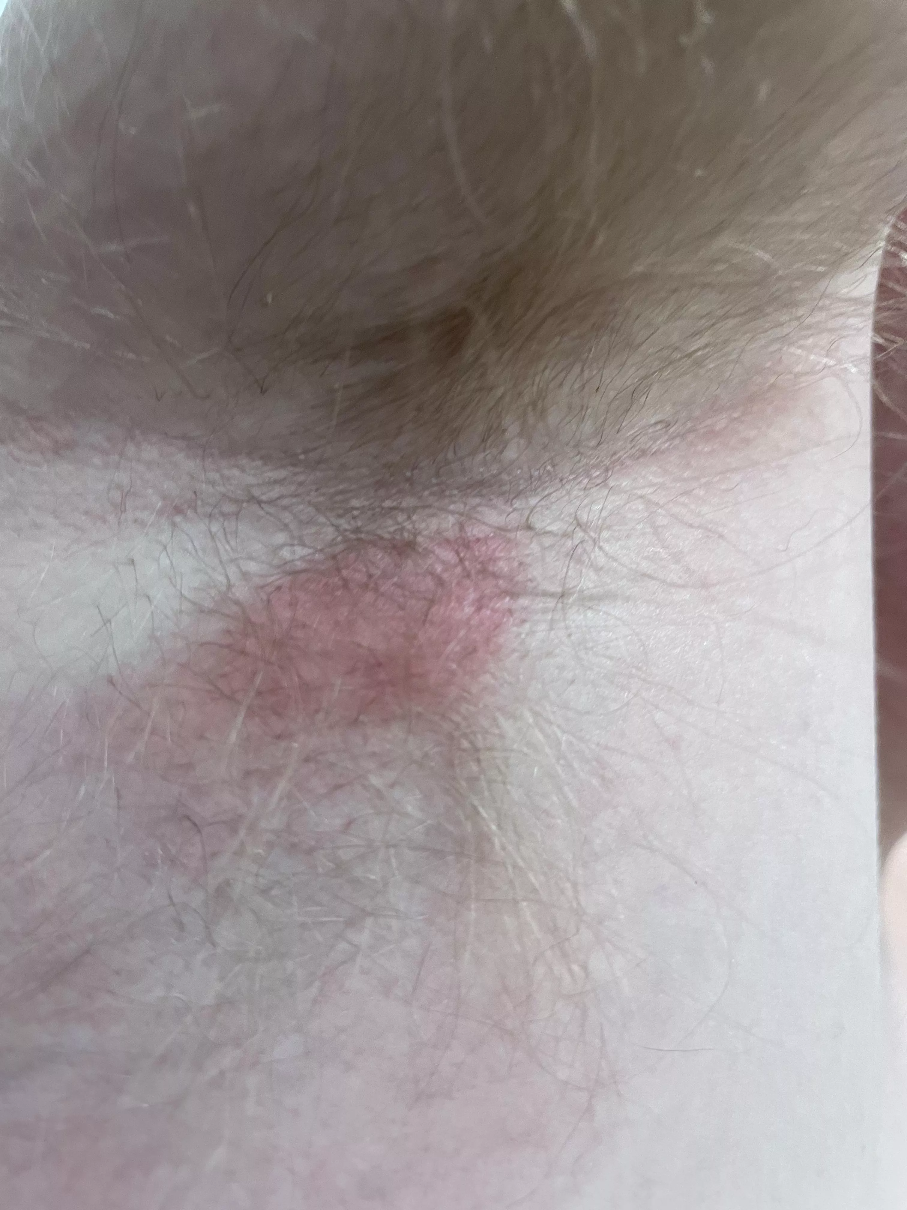 Flair up of what my derm thinks is an epidermal inclusion cyst under my armpit. This is the worst/most painful it has ever been, I can’t even lift my arm. Going back to derm tomorrow.