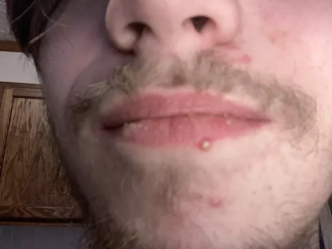 Please excuse my lips 😭 they crusty ik. But I just woke up and saw this huge pimple on my lip, that is a pimple right?? no cold sores? kinda freaked tf out in my head when i saw it and wanted to be sure