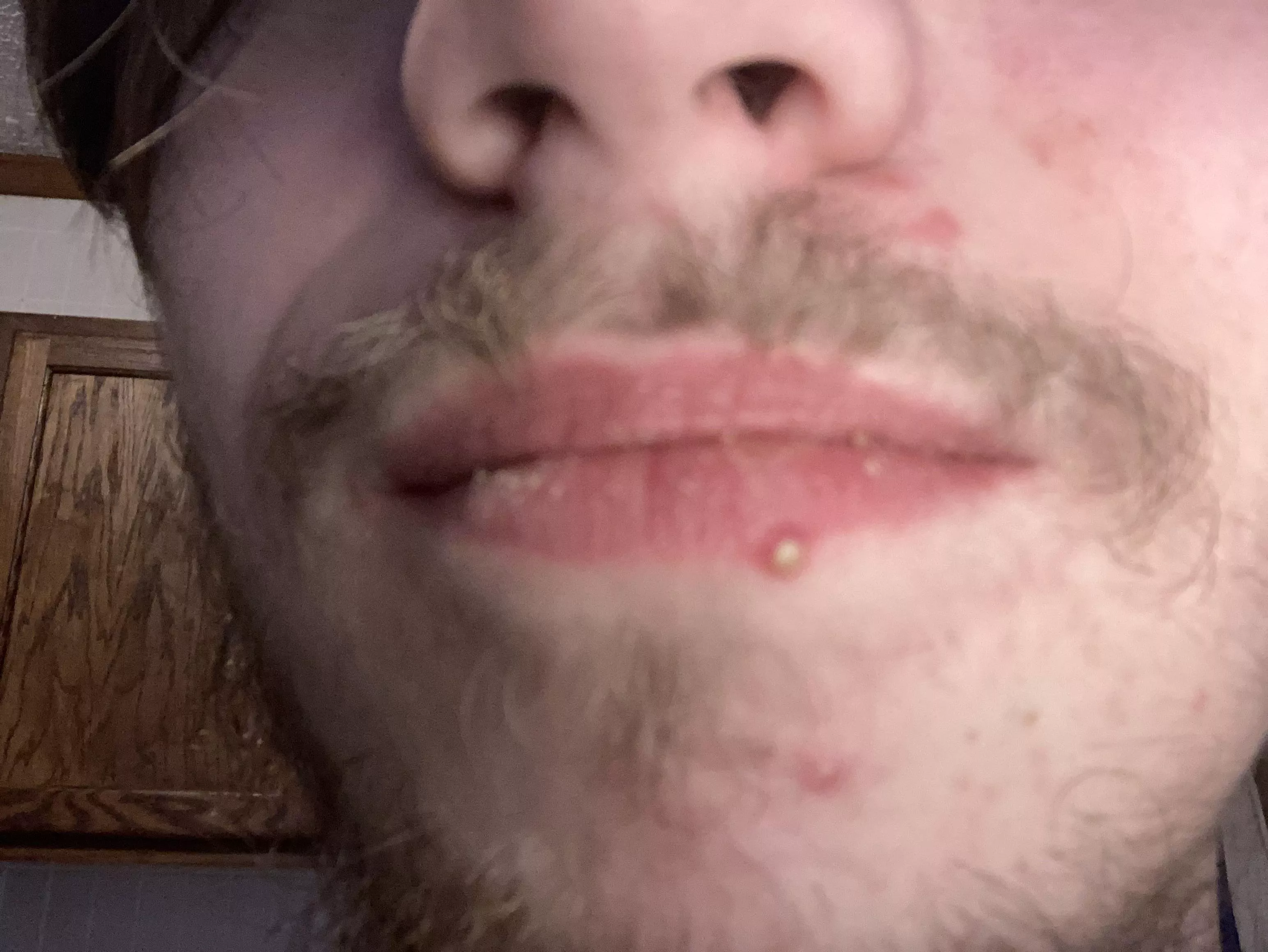 Please excuse my lips 😭 they crusty ik. But I just woke up and saw this huge pimple on my lip, that is a pimple right?? no cold sores? kinda freaked tf out in my head when i saw it and wanted to be sure