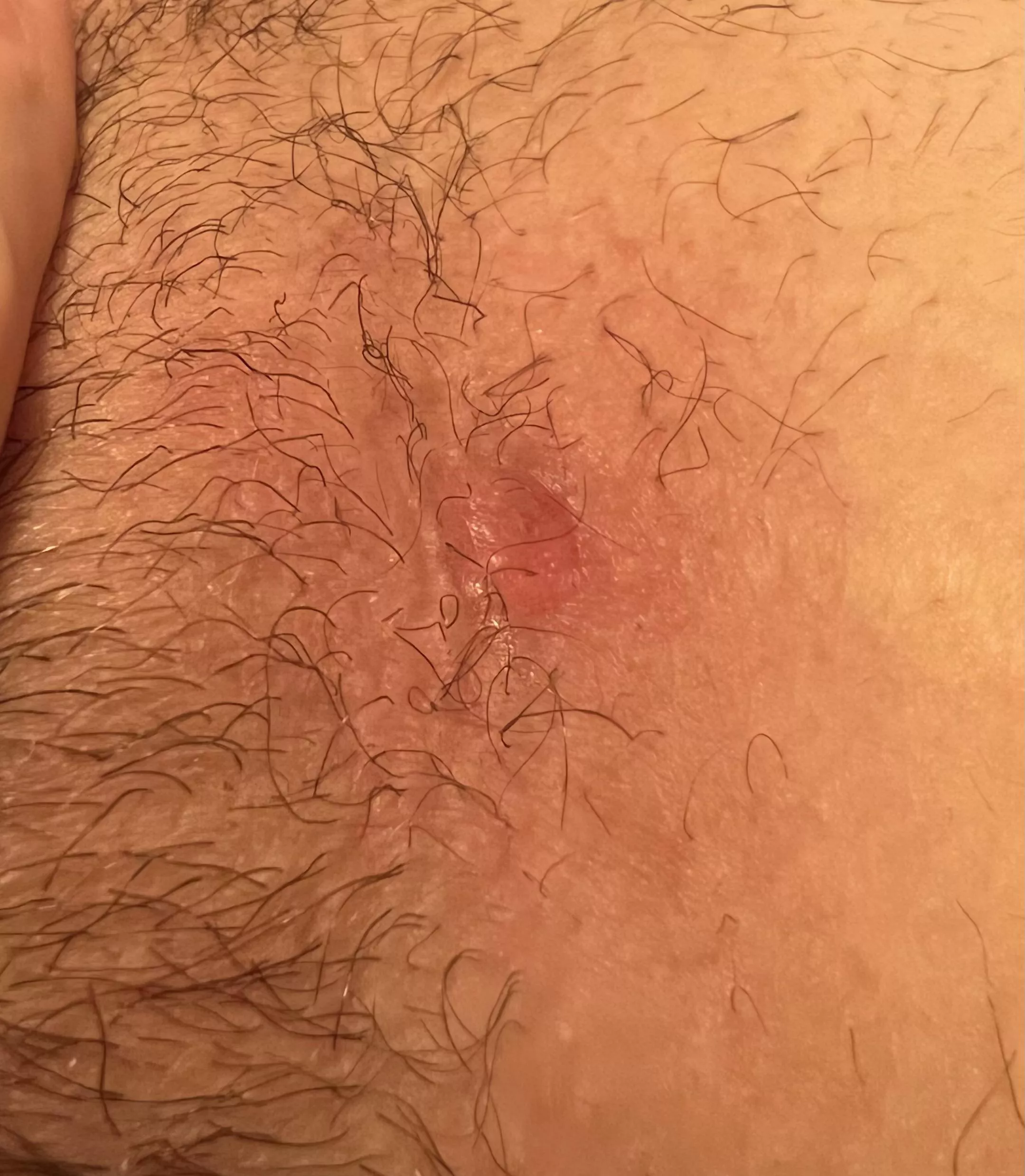 Y’all does this look infected? It’s very red and it won’t go away. I usually get reoccurring cysts on my bikini line but this one looking rough (sorry idk where to ask about this)