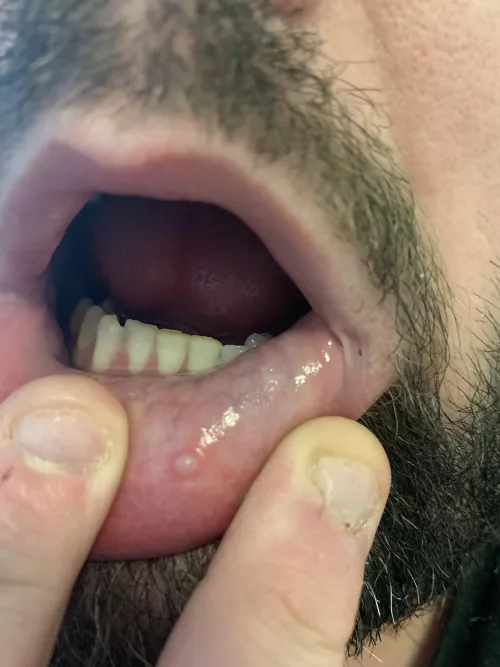 Anyone have any idea what this is on my inner lip?