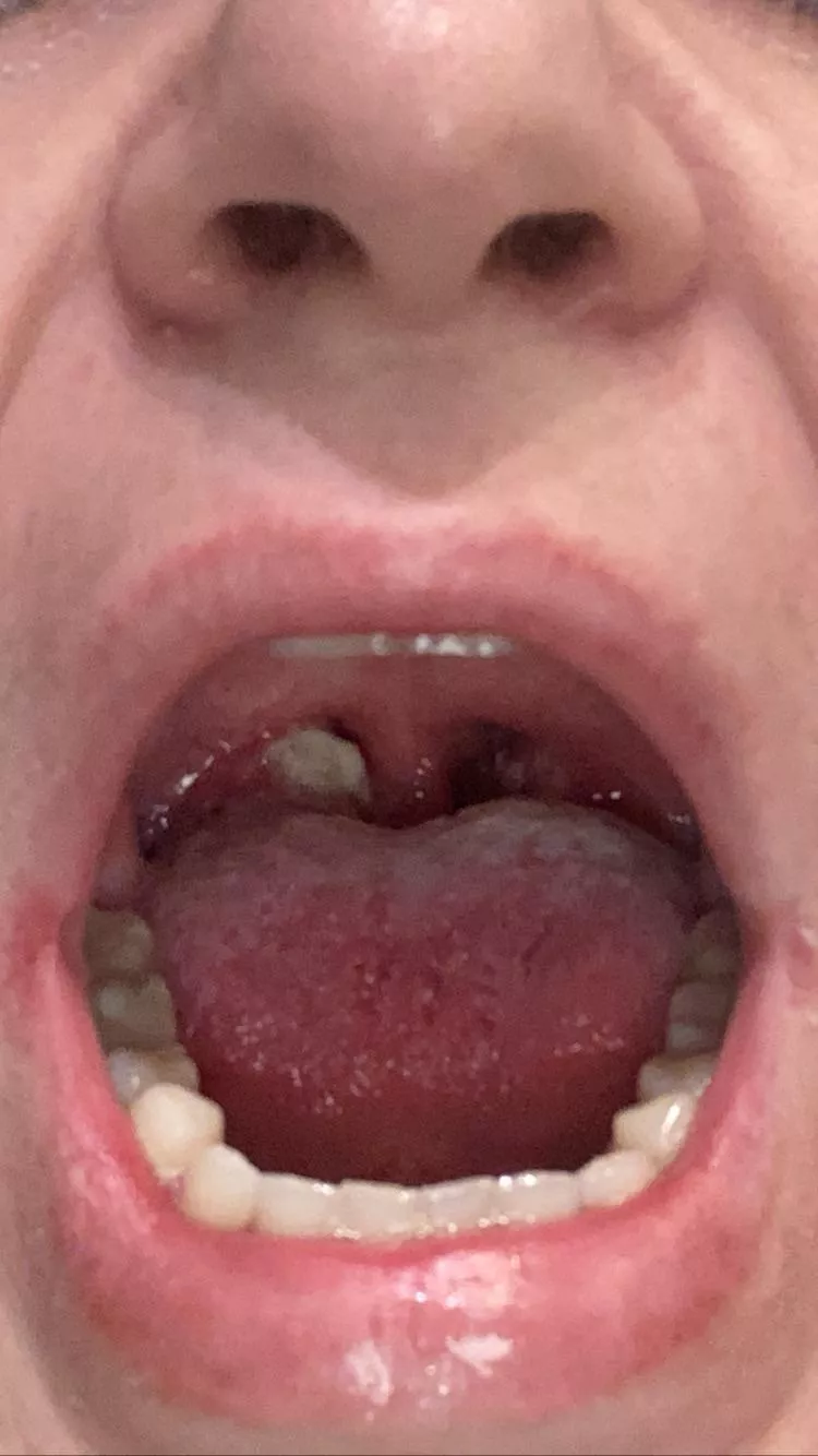 Is this a tonsil stone? (More info in comments)