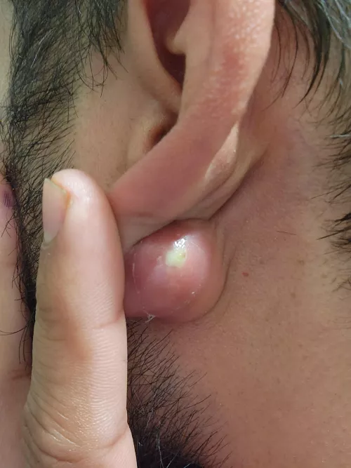 Cyst on my earlobe that grew over a few days.