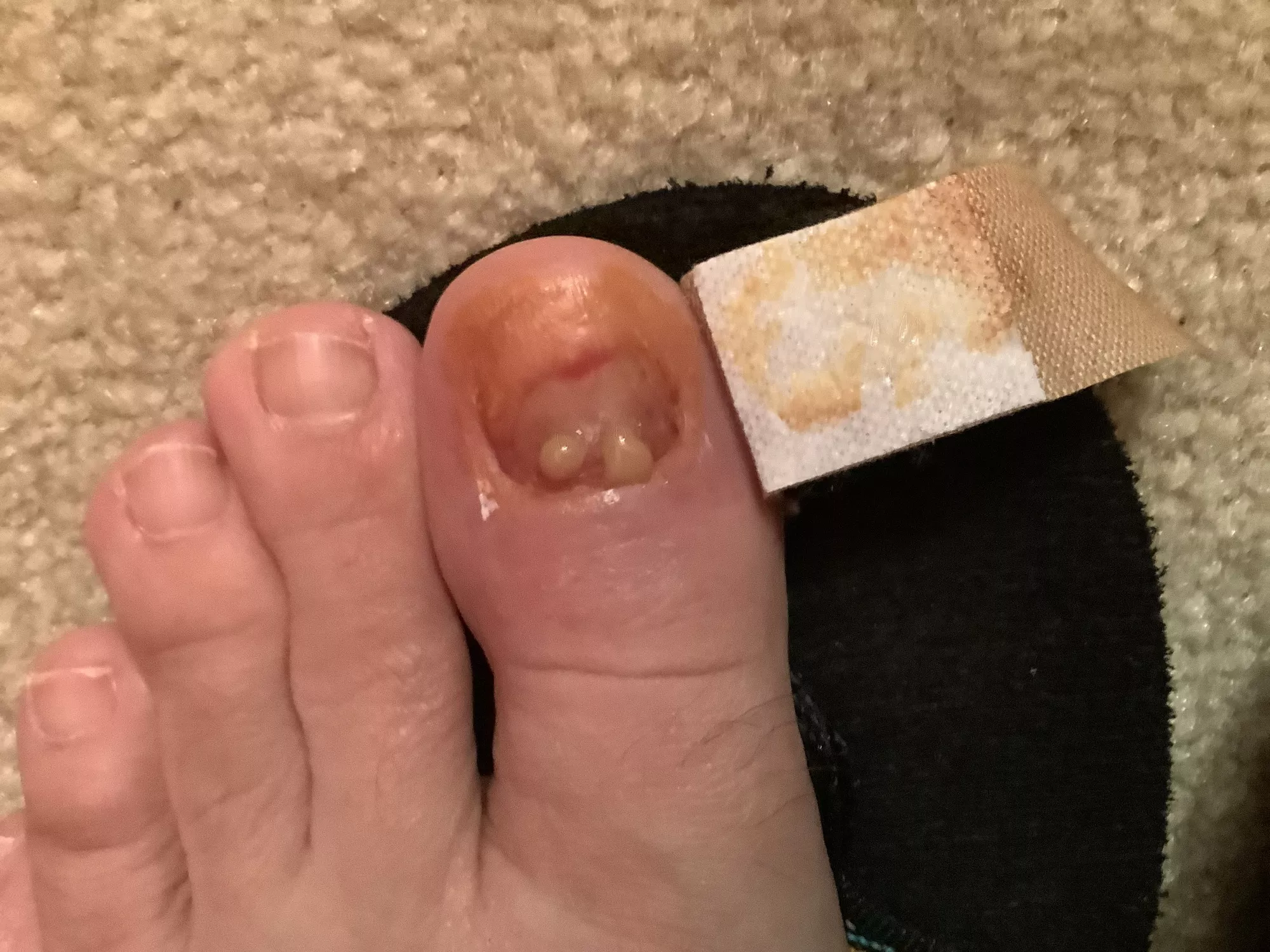 Gross toe goo post radical nail removal, some healing
