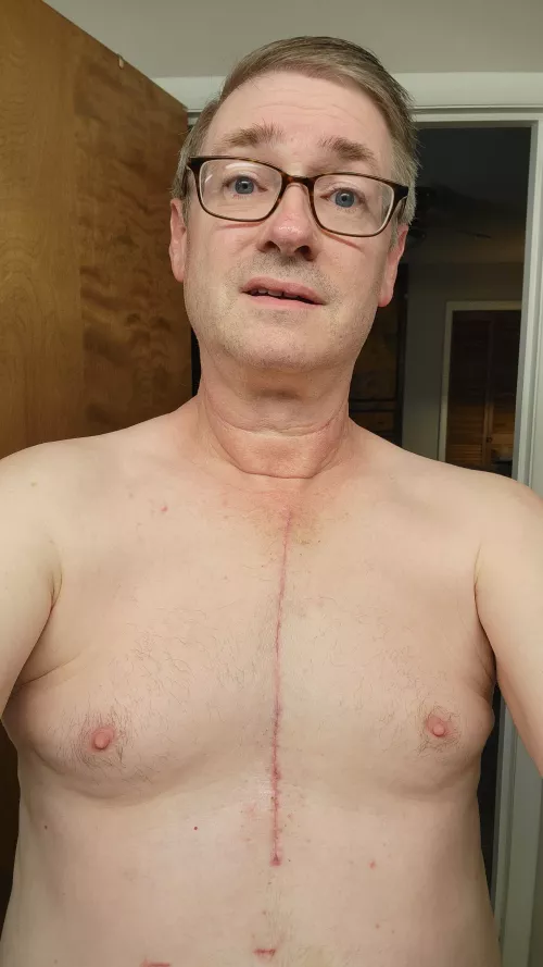 My new scar [56; 178#; 5'11