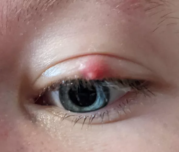 will my chalazion pop on its own?