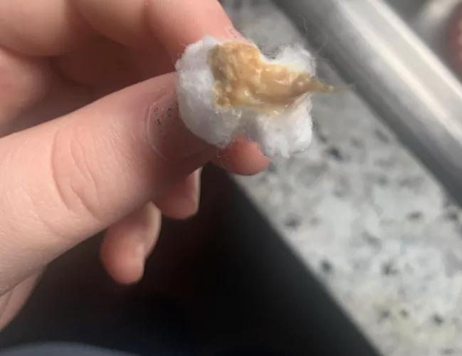 From my infected, ruptured ear drum (Being treated for it- no need to worry!)