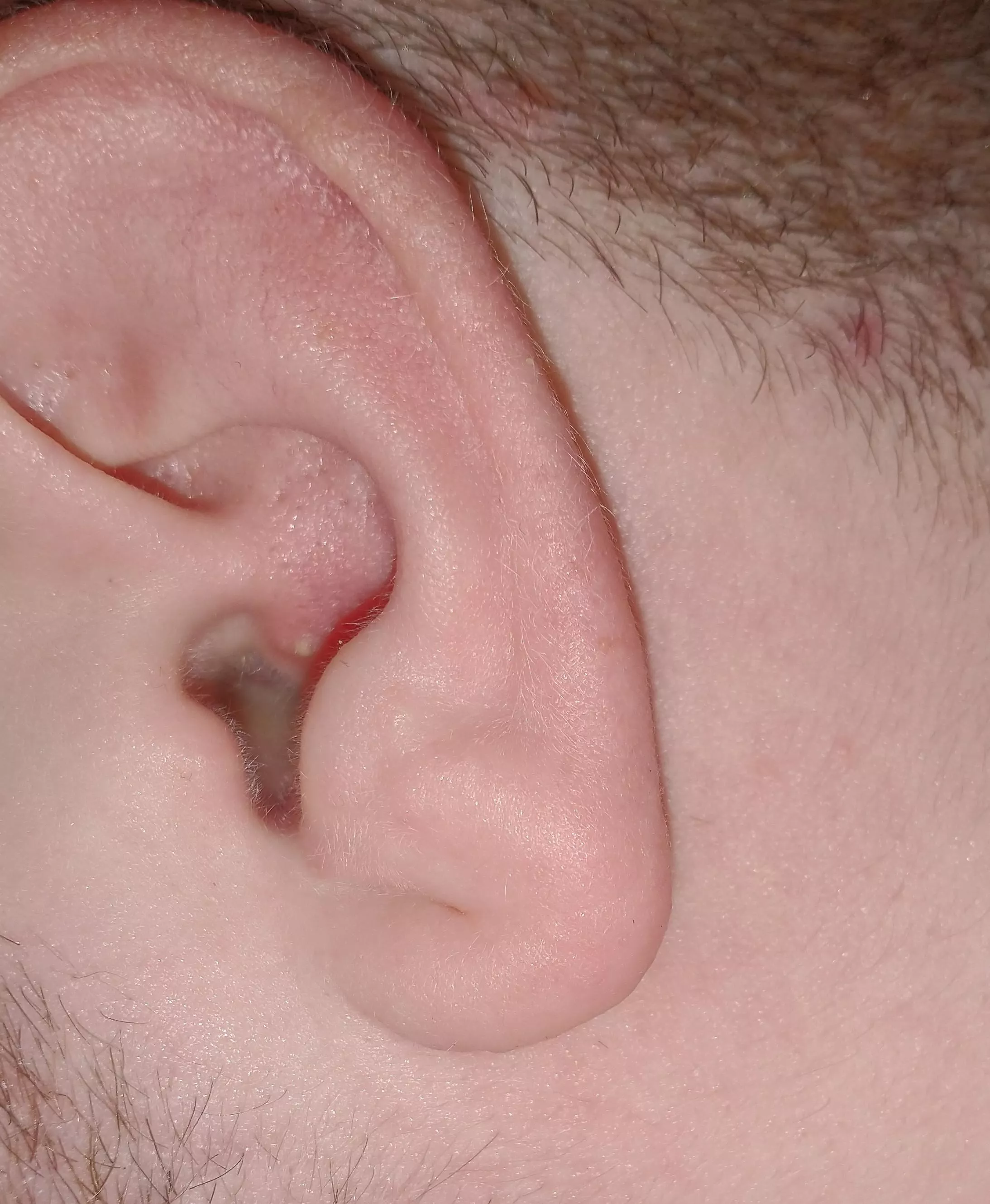 my ear hurt a lot, took a pic and saw this. yowch