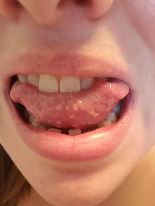 Anyone else get these clear bumps on the underside of their tongue? They're very painful unless I pop them.