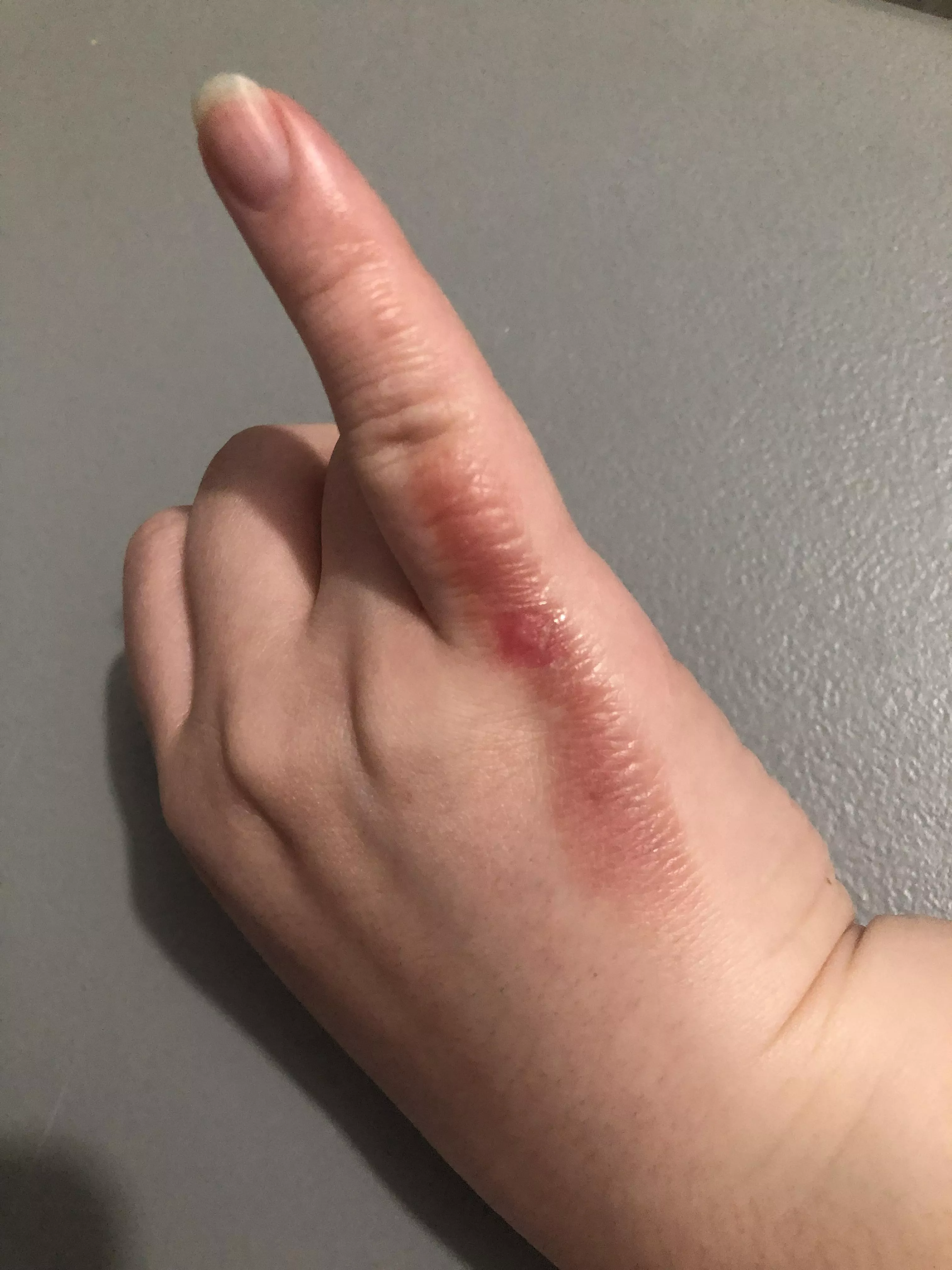 Forbidden pop popped and peeled on its own. Just as itchy as it’s painful.