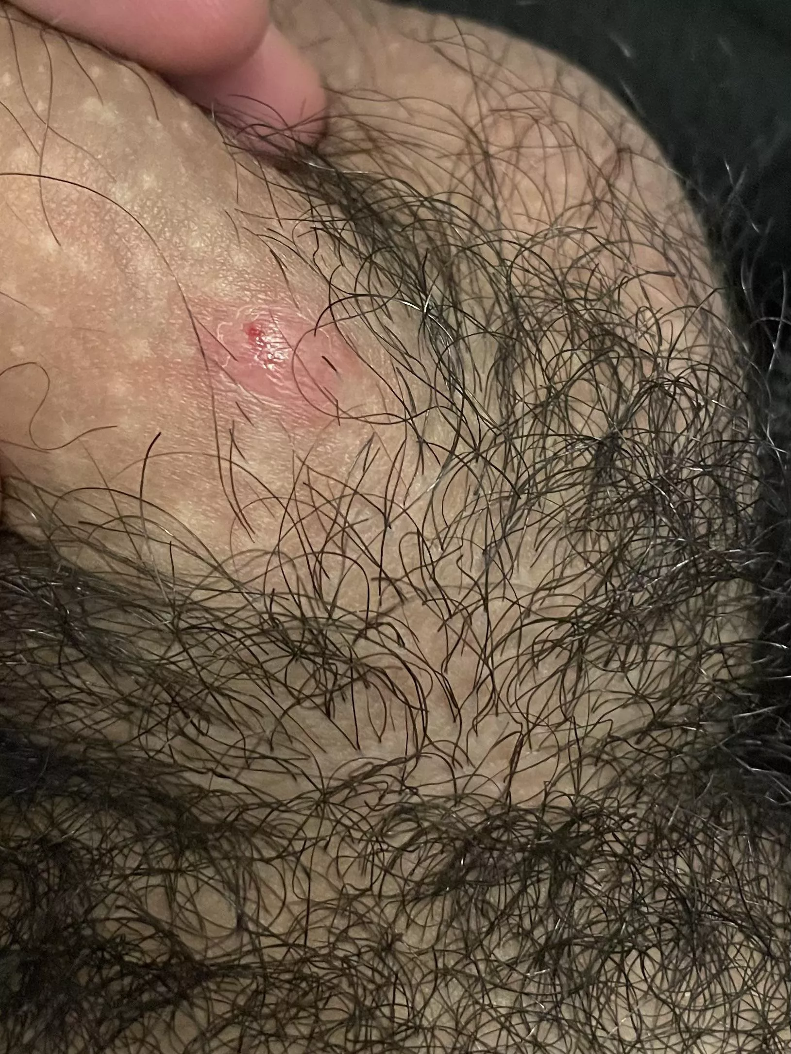 Is this an ingrown hair or something worse?