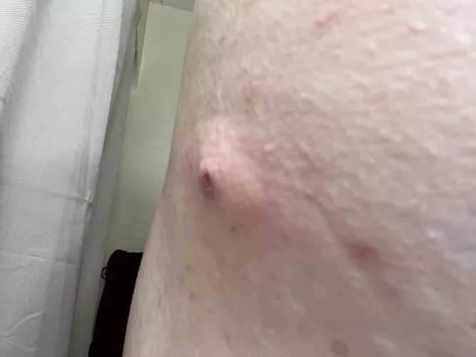My wife will make me pop things for her, but the one thing I need her to pop, a cyst I can barely reach, she won't do it. And when she tried today after pestering her for a while (it hurt from me scratching it accidentally), she couldn't get anything o