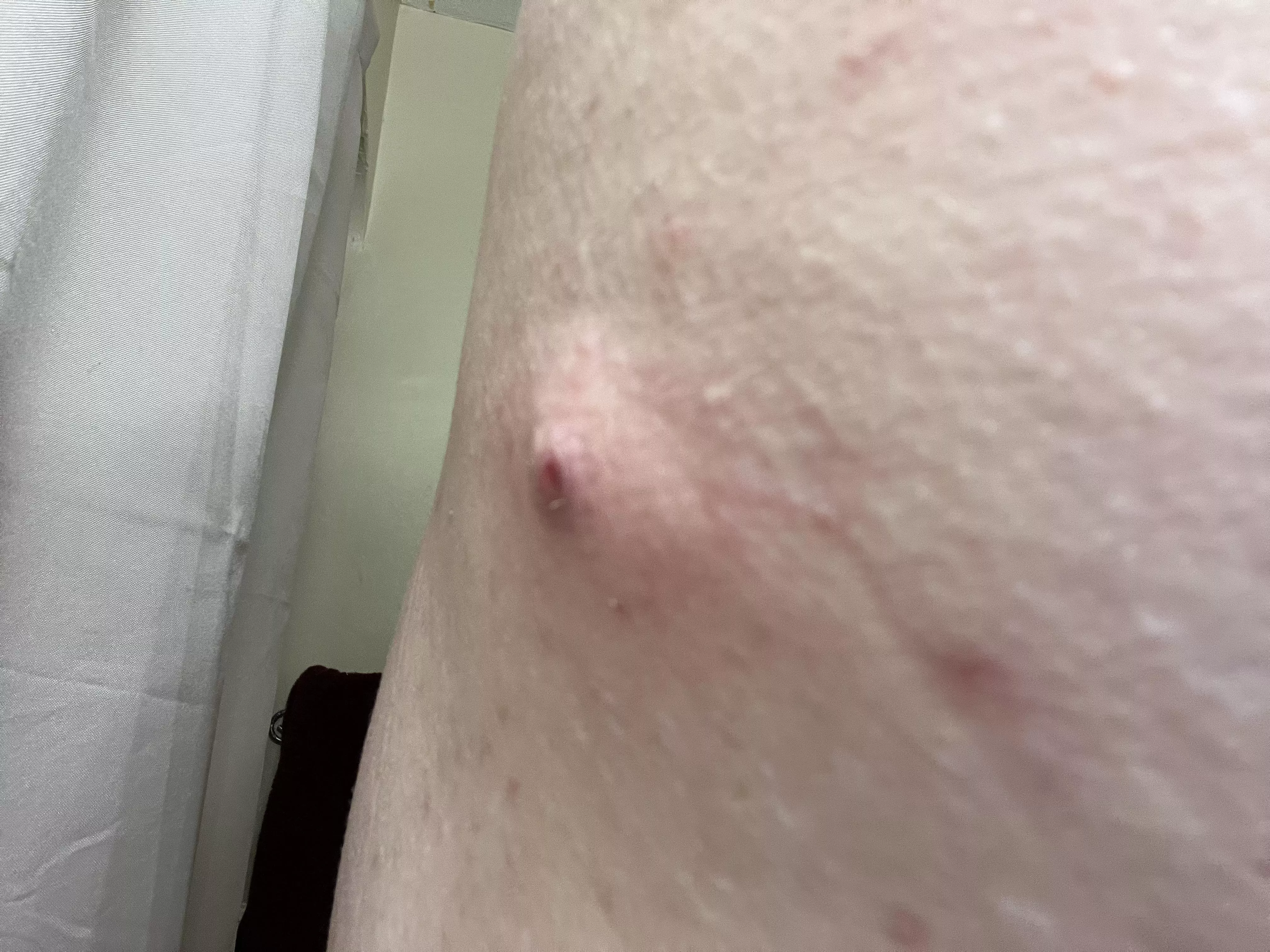 My wife will make me pop things for her, but the one thing I need her to pop, a cyst I can barely reach, she won't do it. And when she tried today after pestering her for a while (it hurt from me scratching it accidentally), she couldn't get anything o