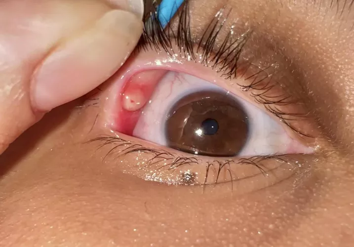 Stye Update #1: just did a warm compress and it helped with the pain any advice?